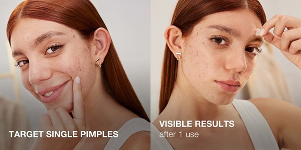 Purchase Neutrogena Stubborn Acne Pimple Patches, Acne Treatment for Face, Ultra-Thin Hydrocolloid Spot Stickers Provide Optimal Healing for Pimples, 24 Patches on Amazon.com