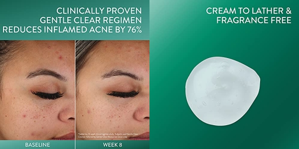 Purchase Cetaphil Acne Face Wash, Gentle Clear Clarifying Acne Cream Cleanser for Sensitive Skin, 4.2oz on Amazon.com